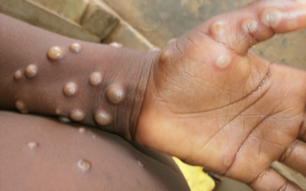 NCDC Confirms Four Deaths and 157 Monkeypox cases,, NCDC Confirms Four Deaths and 157 Monkeypox cases,, INFINITY LOADED